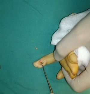 U cuộn mạch búp ngón tay: 1 tổn thương hiếm gặp